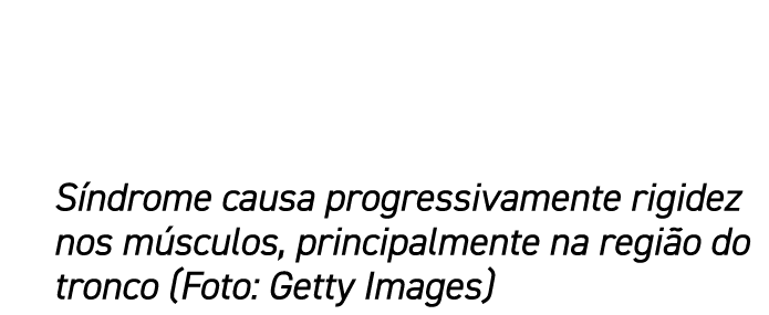 S ndrome causa progressivamente rigidez nos m sculos, principalmente na regi o do tronco (Foto: Getty Images)
