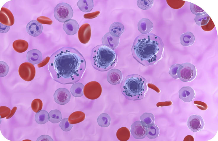 Acute myeloid leukemia AML is a type of blood cancer. It starts in your bone marrow, the soft inner parts of bones. AML usually begins in cells that turn into white blood cells, but it can start in other blood-forming cells, as well.